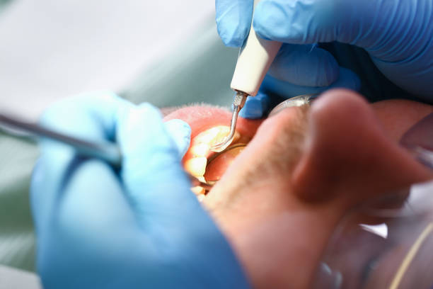 Best Emergency Root Canal Treatment in Parole, MD