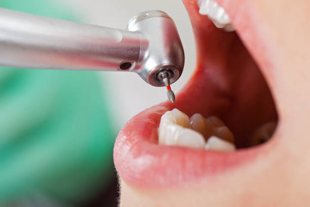 Best Emergency Tooth Extraction in Parole, MD